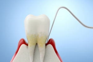 περιοδοντίτιδα σιωπηλός εχθρός